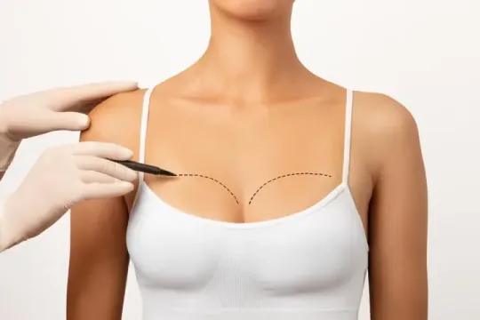 Mastopexia — levantamento das mamas com ou sem prótese de silicone